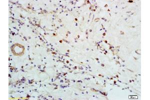 Formalin-fixed and paraffin embedded human breast carcinoma labeled with Anti-CXCR5 Polyclonal Antibody, Unconjugated (ABIN701380) at 1:200 followed by conjugation to the secondary antibody and DAB staining