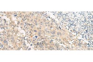 Immunohistochemistry of paraffin-embedded Human cervical cancer tissue using GPR22 Polyclonal Antibody at dilution of 1:50(x200) (GPR22 antibody)