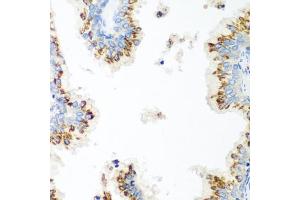 Immunohistochemistry of paraffin-embedded human prostate using UBI antibody (ABIN6134946, ABIN6149845, ABIN6149848 and ABIN6223555) at dilution of 1:100 (40x lens).