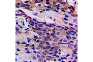 Immunohistochemical analysis of CDK5 (pY15) staining in human breast cancer formalin fixed paraffin embedded tissue section. (CDK5 antibody  (N-Term, pTyr15))