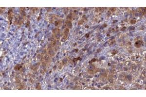 ABIN6276857 at 1/100 staining Human liver cancer tissue by IHC-P. (CD3 epsilon antibody  (C-Term))