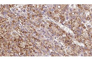 ABIN6279610 at 1/100 staining Human liver cancer tissue by IHC-P. (CHRNB4 antibody  (Internal Region))