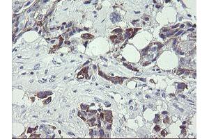 Immunohistochemical staining of paraffin-embedded Adenocarcinoma of Human breast tissue using anti-TDO2 mouse monoclonal antibody.
