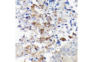 Immunohistochemistry of paraffin-embedded human lung cancer using CD68 Rabbit pAb (ABIN6132070, ABIN6138218, ABIN6138221 and ABIN6217224) at dilution of 1:50 (40x lens). (CD68 antibody  (AA 22-319))