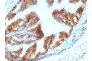 Immunohistochemistry (IHC) image for anti-Epithelial Cell Adhesion Molecule (EPCAM) (AA 280-350), (Cytoplasmic Domain) antibody (ABIN6939974)