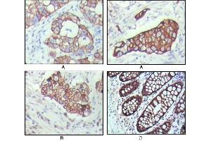 Immunohistochemical analysis of paraffin-embedded human breast carcinoma(A), lung cancer(B) and normal colon tissue(C), showing cytoplasmic localization with DAB staining using KRT19 mouse mAb. (Cytokeratin 19 antibody)