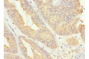 Immunohistochemistry of paraffin-embedded human endometrial cancer using ABIN7167233 at dilution of 1:100 (RAB17 antibody  (AA 1-212))