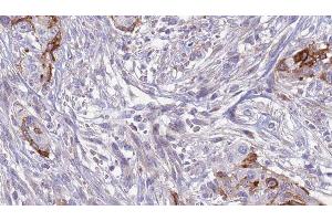 ABIN6277621 at 1/100 staining Human urothelial cancer tissue by IHC-P. (SLC3A1 antibody  (C-Term))
