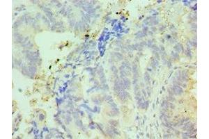 Immunohistochemistry of paraffin-embedded human colon cancer using ABIN7156999 at dilution of 1:100 (IFT57 antibody  (AA 170-429))