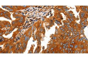 Immunohistochemistry of paraffin-embedded Human ovarian cancer using CAP2 Polyclonal Antibody at dilution of 1:50 (CAP2 antibody)
