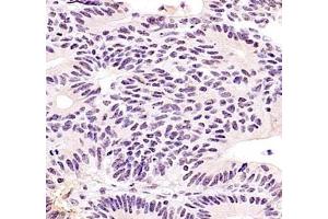 Immunohistochemistry of paraffin embedded human colon cancer using ZKSCAN4 (ABIN7076265) at dilution of 1:400 (400x lens) (ZKSCAN4 antibody)