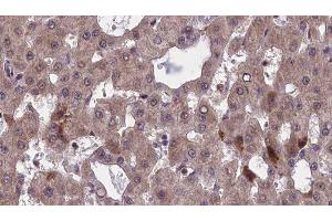 ABIN6277501 at 1/100 staining Human liver cancer tissue by IHC-P. (CHRNB1 antibody  (N-Term))