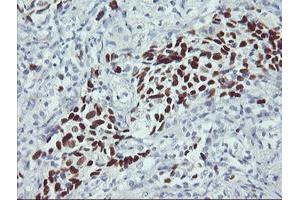 Immunohistochemical staining of paraffin-embedded Carcinoma of Human lung tissue using anti-TP53 mouse monoclonal antibody.