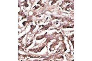 Formalin-fixed and paraffin-embedded human cancer tissue reacted with the primary antibody, which was peroxidase-conjugated to the secondary antibody, followed by DAB staining.