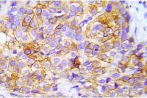 Immunohistochemistry (IHC) analyzes of p-CrkL (Try207) antibody in paraffin-embedded human lung adenocarcinoma tissue.