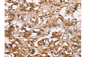 The image on the left is immunohistochemistry of paraffin-embedded Human thyroid cancer tissue using ABIN7189818(ANXA2R Antibody) at dilution 1/25, on the right is treated with synthetic peptide. (Chromosome 5 Open Reading Frame 39 (C5orf39) antibody)