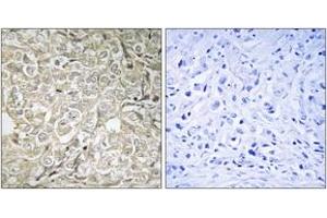 Immunohistochemistry analysis of paraffin-embedded human prostate carcinoma tissue, using RAB37 Antibody.