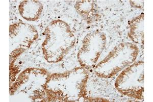 Immunohistochemical analysis of Paraffin-Embedded GASTRIC CA, using AP31129PU-N RGS14 antibody at 1/100 dilution. (RGS14 antibody  (AA 504-516))