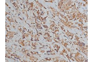 ABIN6267039 at 1/50 staining human breast cancer tissue sections by IHC-P. (Histone 3 antibody)