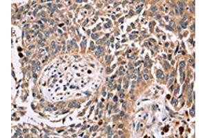 The image on the left is immunohistochemistry of paraffin-embedded Human lung cancer tissue using ABIN7129551(FUCA1 Antibody) at dilution 1/30, on the right is treated with fusion protein.