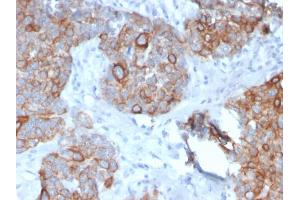 Formalin-fixed, paraffin-embedded human Prostate Carcinoma stained with STAT2 Mouse Monoclonal Antibody (STAT2/2650). (STAT2 antibody)