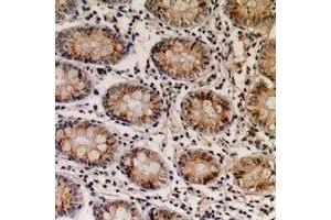 Immunohistochemical analysis of NTPCR staining in human colon cancer formalin fixed paraffin embedded tissue section.