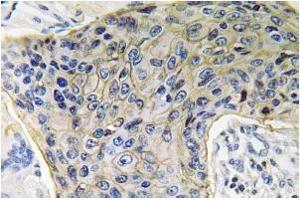 Immunohistochemistry analysis of AQP4 Antibody in Paraffin-Embedded Human lung carcinoma tissue. (Aquaporin 4 antibody)
