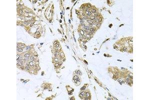 Immunohistochemistry of paraffin-embedded Human gastric cancer using SBDS Polyclonal Antibody at dilution of 1:100 (40x lens). (SBDS antibody)