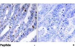 Immunohistochemical analysis of paraffin-embedded human colon carcinoma tissue using PRKAR2B polyclonal antibody . (PRKAR2B antibody  (Ser113))