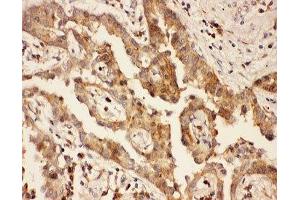 IHC-P: CXCR3 antibody testing of human lung cancer tissue (CXCR3 antibody  (AA 1-368))