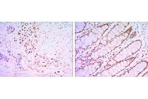 Immunohistochemical analysis of paraffin-embedded lung cancer tissues (left) and human rectum tissues (right) using KLF4 mouse mAb with DAB staining. (KLF4 antibody  (AA 2-470))