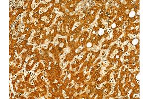 ABIN7094414 and ABIN7098461 at 1/100 staining Human pancreatic cancer by IHC-P. (OGDHL antibody  (Internal Region))
