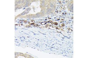 Immunohistochemistry of paraffin-embedded human colon carcinoma using von Willebrand factor (VWF) Rabbit pAb (ABIN3015449, ABIN3015450, ABIN5663874 and ABIN6217310) at dilution of 1:50 (40x lens). (VWF antibody  (AA 50-150))