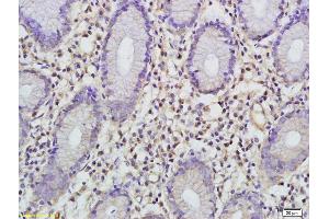 Formalin-fixed and paraffin embedded human gastric carcinoma labeled with Anti-FBP1 Polyclonal Antibody, Unconjugated (ABIN752053) at 1:200 followed by conjugation to the secondary antibody (FBP1 antibody  (AA 31-130))