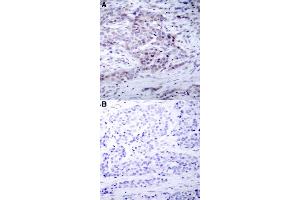 Immunohistochemical staining of human breast cancer tissue with NFKB2 (phospho S870) polyclonal antibody  without blocking peptide (A) or preincubated with blocking peptide (B) under 1:50-1:100 dilution. (NFKB2 antibody  (pSer870))