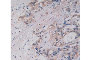 IHC-P analysis of Human Tissue, with DAB staining. (M-CSF/CSF1 antibody  (AA 33-496))