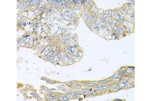 Immunohistochemistry of paraffin-embedded Human colon carcinoma using HDAC3 Polyclonal Antibody at dilution of 1:100 (40x lens). (HDAC3 antibody)