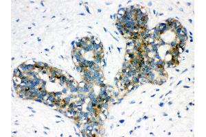 Anti-ARSA Picoband antibody,IHC(P) IHC(P): Human Mammary Cancer Tissue (Arylsulfatase A antibody  (C-Term))