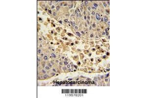 Formalin-fixed and paraffin-embedded human hepatocarcinoma with COLEC11 Antibody (N-term), which was peroxidase-conjugated to the secondary antibody, followed by DAB staining.