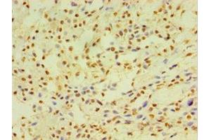 Immunohistochemistry of paraffin-embedded human breast cancer using ABIN7149254 at dilution of 1:100 (CYP2J2 antibody  (AA 328-502))