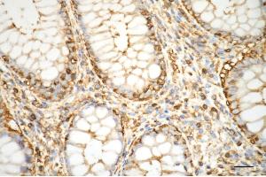 Immunohistochemistry was performed on paraffin-embedded human sigmoid colon carcinoma using alpha smooth muscle actin antibody (ABIN7797464), 1:200). (Recombinant Smooth Muscle Actin antibody)