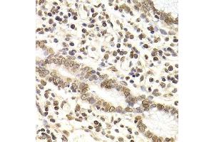 Immunohistochemistry of paraffin-embedded human gastric cancer using LMNB2 Antibody. (Lamin B2 antibody  (AA 341-620))