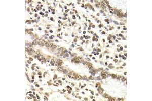 Immunohistochemistry of paraffin-embedded human gastric cancer using LMNB2 Antibody.