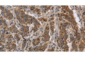 Immunohistochemistry of paraffin-embedded Human liver cancer using KCNQ4 Polyclonal Antibody at dilution of 1:40 (KCNQ4 antibody)