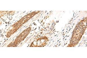 Immunohistochemistry of paraffin-embedded Human esophagus cancer tissue using DCAF10 Polyclonal Antibody at dilution of 1:130(x200) (DCAF10 antibody)