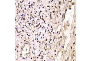 Immunohistochemistry of paraffin-embedded Human mammary cancer using HDAC4 antibody at dilution of 1:100 (x40 lens). (HDAC4 antibody)