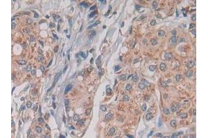 IHC-P analysis of Human Breast cancer Tissue, with DAB staining. (TLR1 antibody  (AA 114-339))