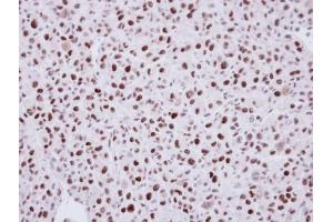 IHC-P Image Immunohistochemical analysis of paraffin-embedded U87 Xenograft, using LDB1, antibody at 1:100 dilution.