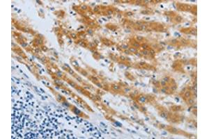 The image on the left is immunohistochemistry of paraffin-embedded Human liver cancer tissue using ABIN7190248(CHRFAM7A Antibody) at dilution 1/40, on the right is treated with synthetic peptide. (CHRNA7 antibody)