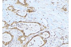 ABIN6275280 at 1/100 staining Human lung cancer tissue by IHC-P. (MT-ND1 antibody  (Internal Region))